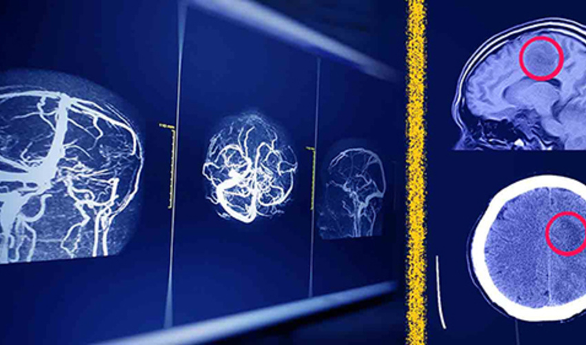 New Solution by Electrical and Computer Engineering Researchers Enhances AI Security in Brain MRI Analysis